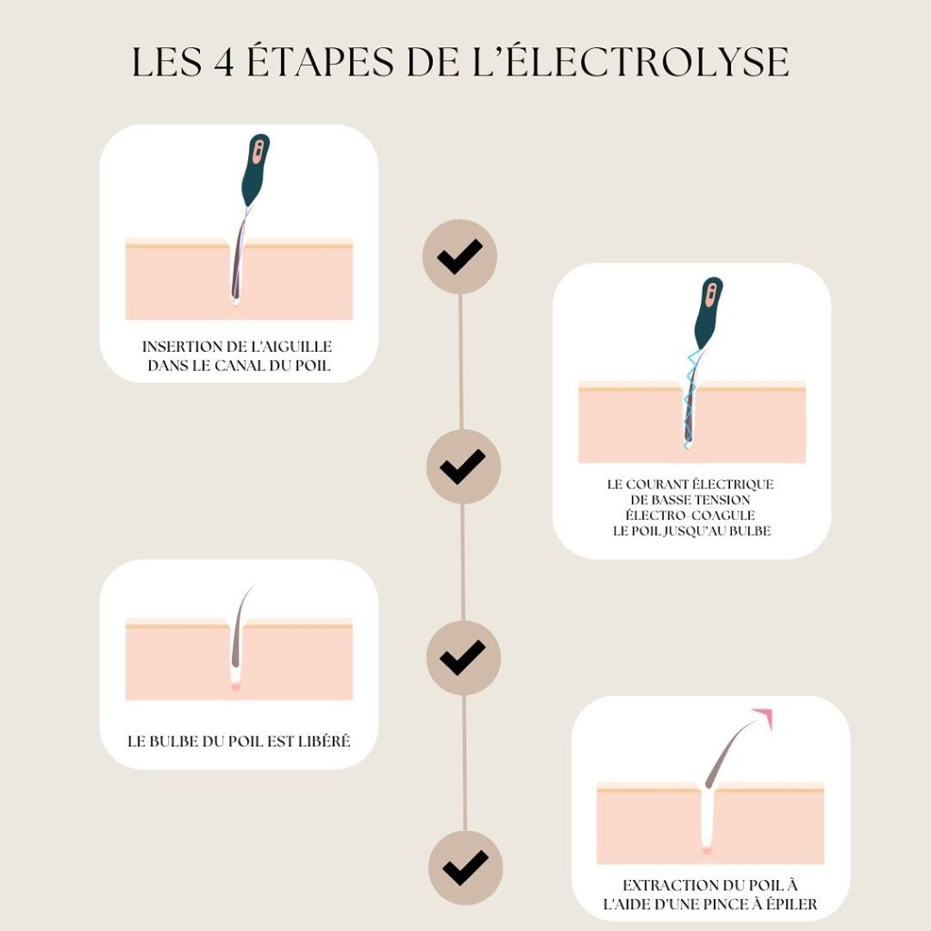 Voici-les-4-etapes-de-destruction-du-poil-avec-lelectrolyse